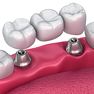 Имплантация зубов комбинированная