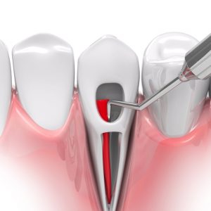 Эндодонтическое лечение зуба при пульпите