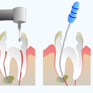 Распломбирование и инструментальная обработка канала зуба