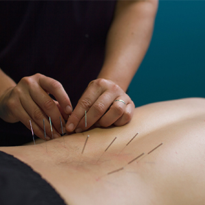 Dry needling (терапия сухими иглами)