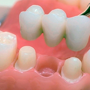 Протезирование зубов (коронки и мосты)
