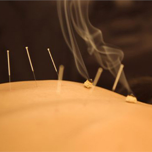 Иглоукалывание