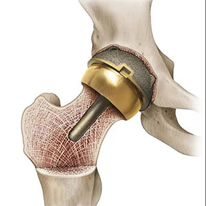Эндопротезирование тазобедренных и коленных суставов