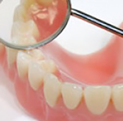 Протезирование зубов съемными конструкциями