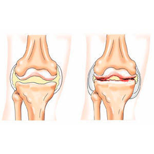 Деформирующий артроз коленного сустава