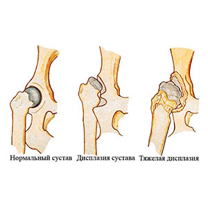 Дисплазия тазобедренных суставов